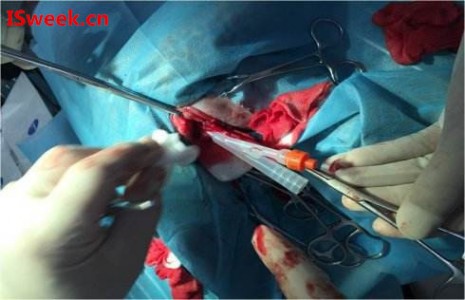 一種用于膀胱內壓監(jiān)測的光纖壓力傳感器FOP-M260