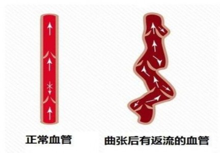 應(yīng)用在無創(chuàng)測量靜脈曲張壓力中的光纖壓力傳感器