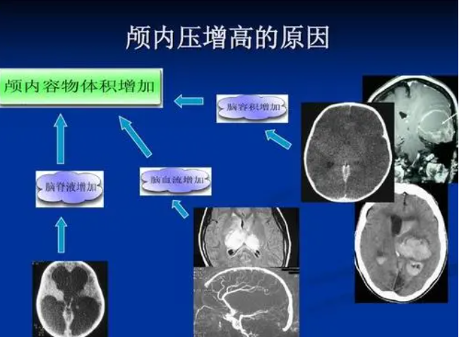 用于顱內(nèi)壓監(jiān)測的光纖壓力傳感器